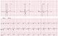 Cardiac Event Recorder Bluetooth ECG Monitor Mobile EKG Telemetry Arrhythmia/HRV Monitoring Wecardio (Alivcore Similar) supplier