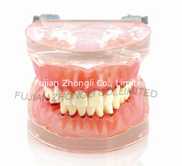 China Dental Transparent gingivitis model pathology oral model dental calculus with metal jaw frame new supplier