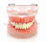 Dental Transparent gingivitis model pathology oral model dental calculus with metal jaw frame new supplier