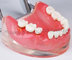 Dental Transparent gingivitis model pathology oral model dental calculus with metal jaw frame new supplier