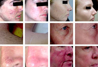 August Big Sale at NUBWAY! skin rejuvenation ipl photofacial machine for home use