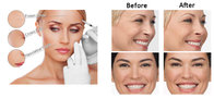 Face ha gel injection diminish facial lines dermal fillers 2 ml for skin tightening