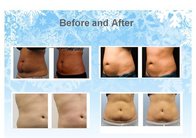 Hot ! fat removal Cryolipo fat freezing machine